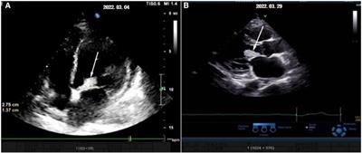Rothia dentocariosa endocarditis with brain abscess and splenic abscess: case report and brief review